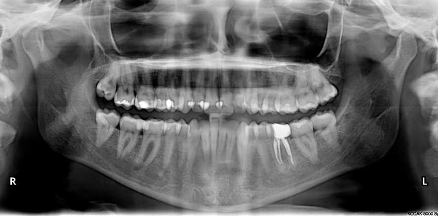 Biokeramische Sealer: die große Erleichterung