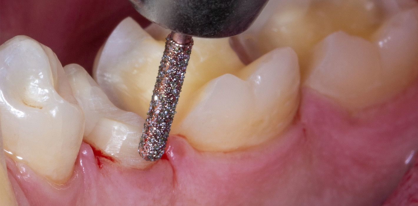 DIAO von Komet Dental: Diamantinstrumente mit Wow-Effekt