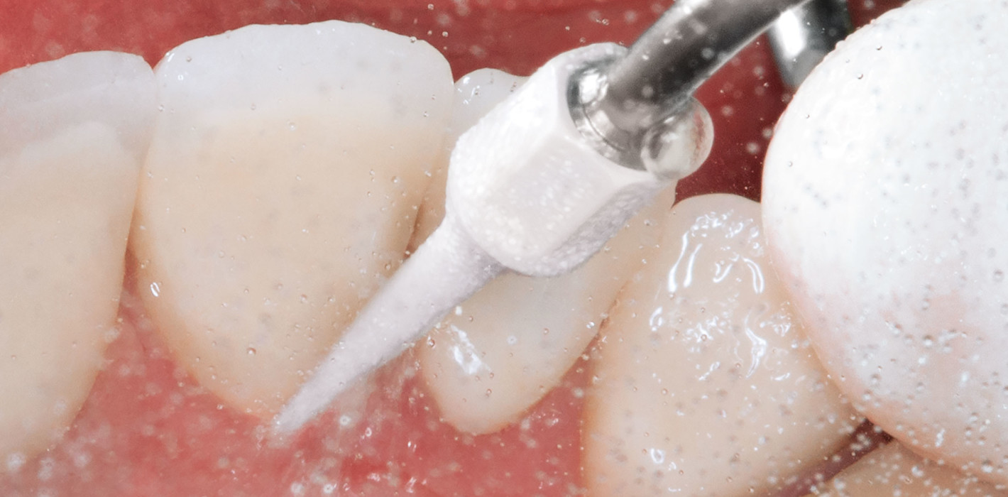 Implantatscaler für ein präzises Oberflächendebridement