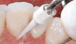Implantatscaler für ein präzises Oberflächendebridement