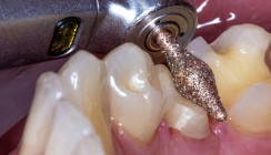 OccluShaper – Mit genialer Form und Beschichtung