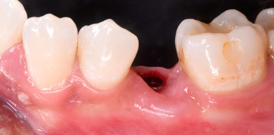 Knochenfräser: Optimale Einheit aus Funktion und Feeling
