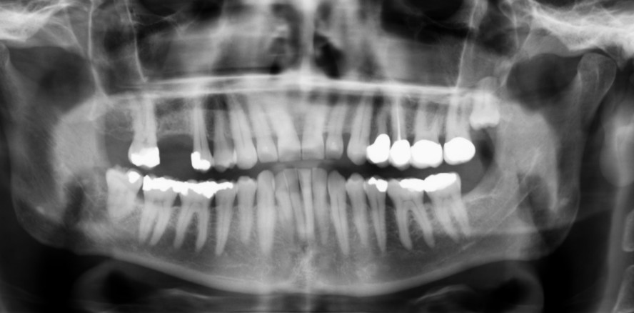 Wurzelkanal­aufbereitung mit wärme­behandelten Feilen