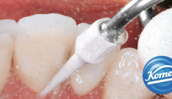 Oberflächendebridement mit kompatiblen Scaler- und Parospitzen