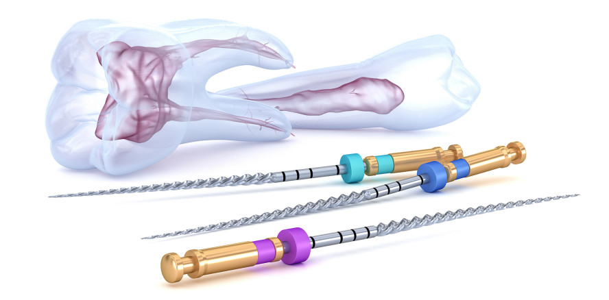 Reziprokes Feilensystem und Endo-Motor – eine zuverlässige Kombination