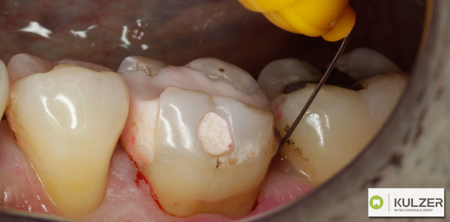 Zuverlässige Lokalanästhesie mit Citocartin® von Kulzer