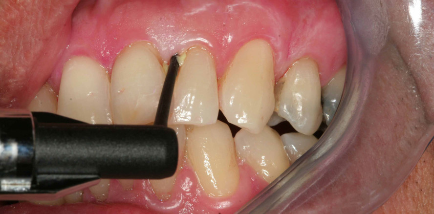 Step-by-step: Parodontaltaschen einfach in den Griff bekommen