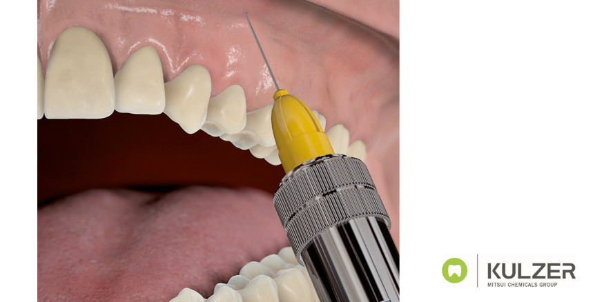 Jetzt mit SOPIRA® von Kulzer bis zu 20 Prozent sparen!