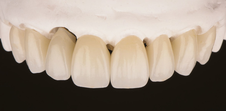 Korrekte Befestigung von Restau­rationen aus Zirkonoxid