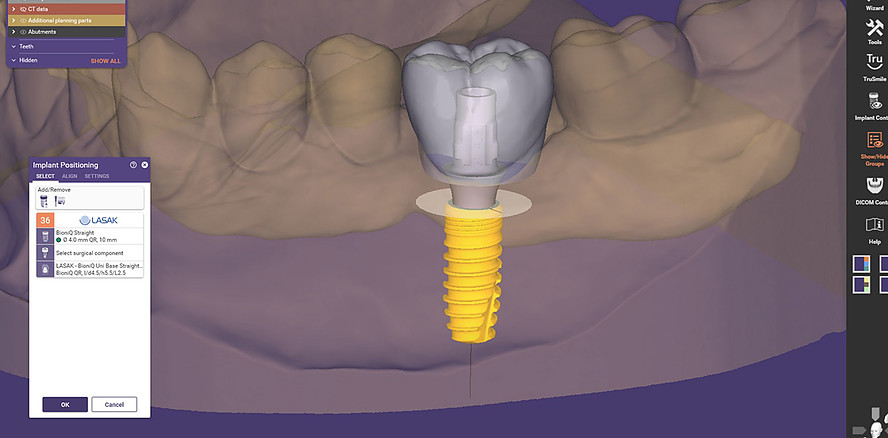 Aktualisierte LASAK CAD-Bibliotheken für exocad jetzt verfügbar