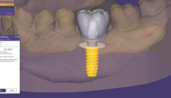 Aktualisierte LASAK CAD-Bibliotheken für exocad jetzt verfügbar