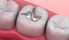 Amalgam ade: Was sollte man zum Verbot wissen