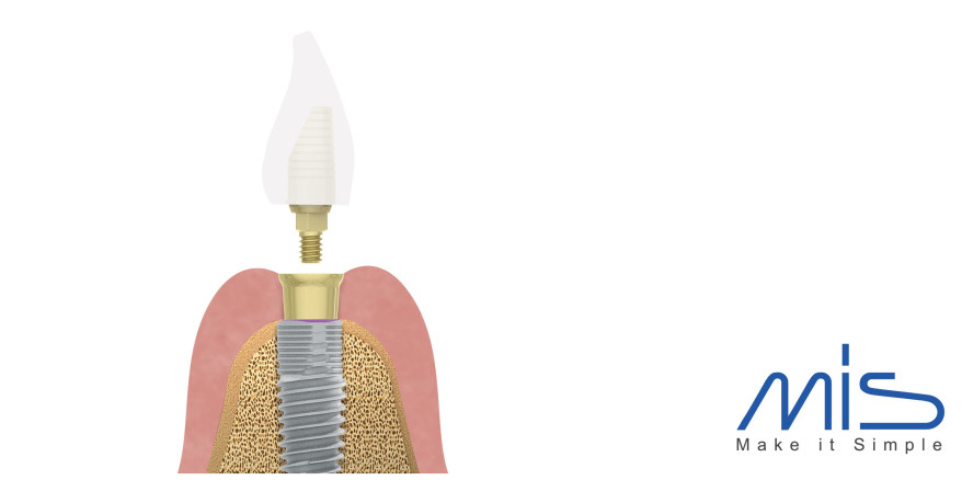 MIS CONNECT – Die verschraubte Lösung
