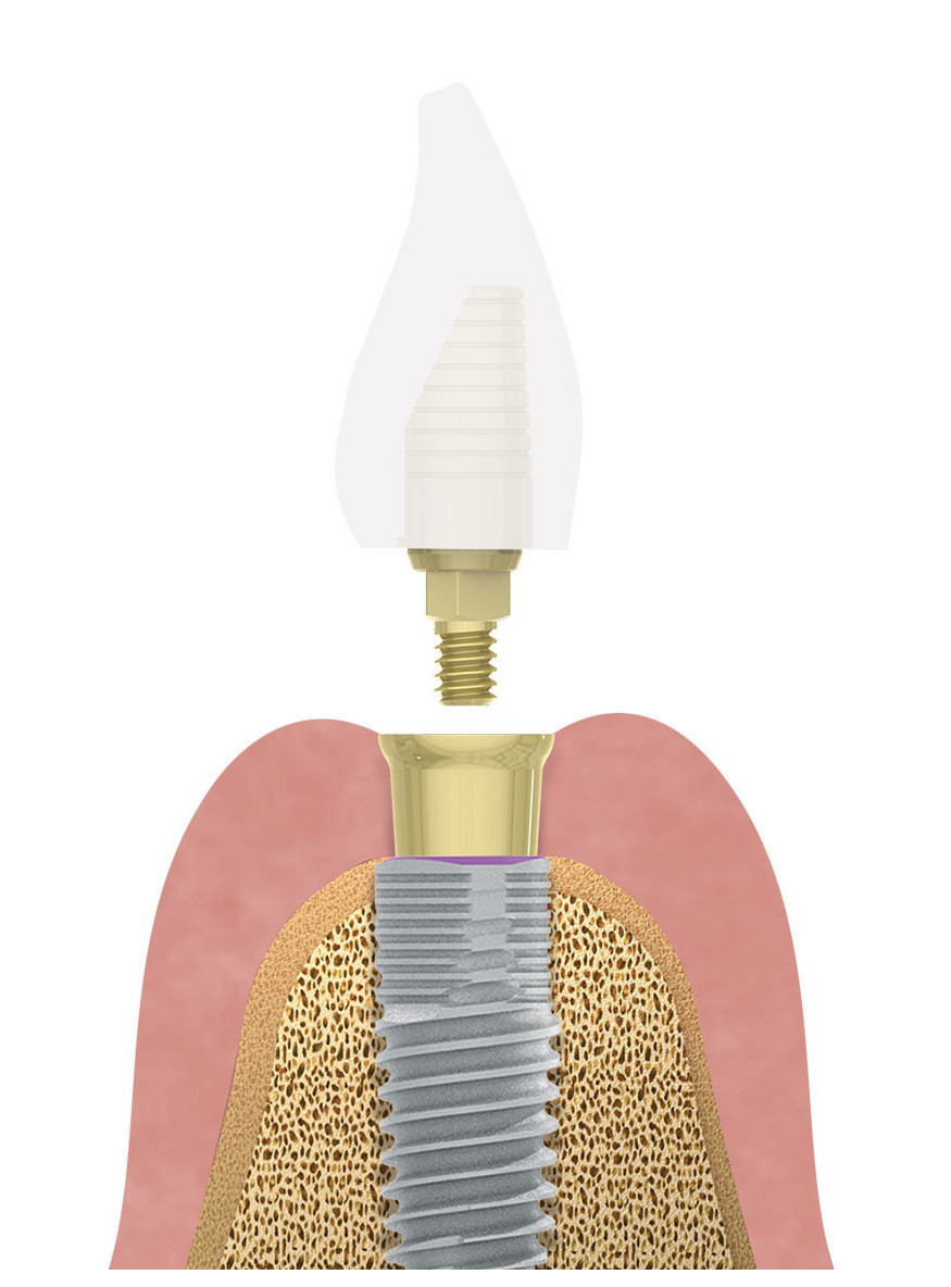 Mis Implants Technologies Gmbh Zwp Online Das Nachrichtenportal Fur Die Dentalbranche
