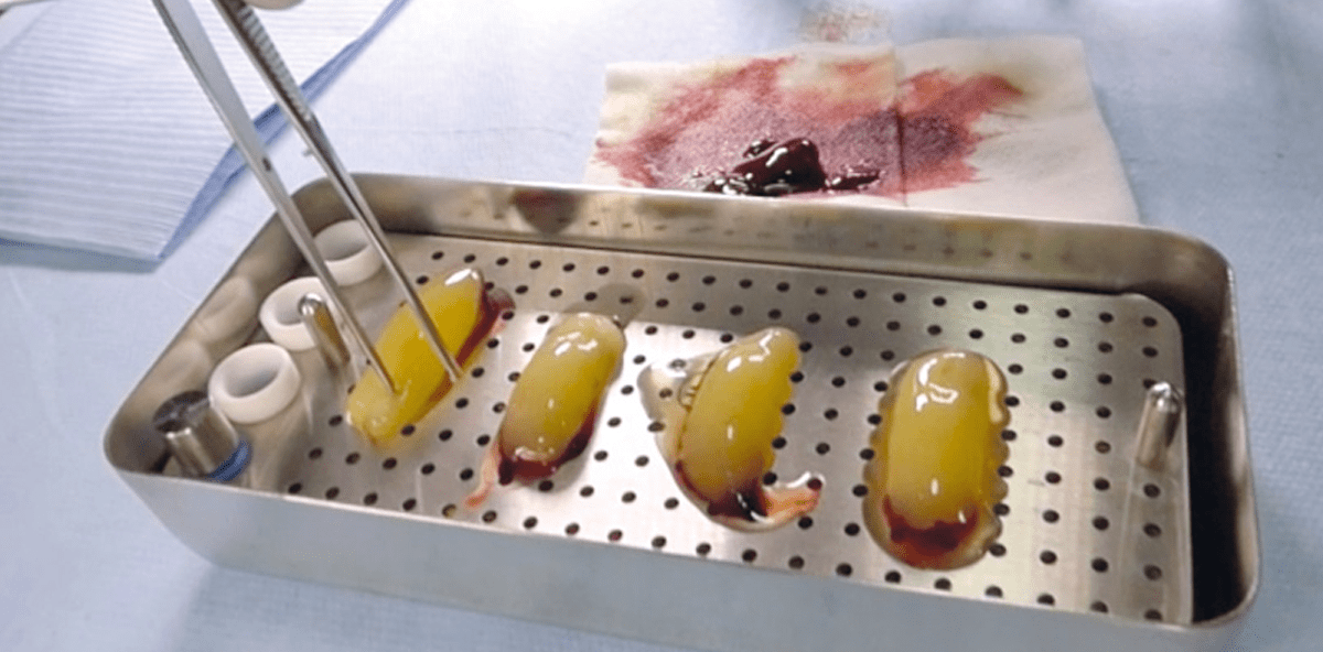 Implantologie: Blutprodukte werden zum Standard