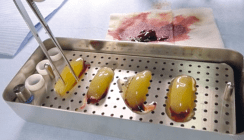 Implantologie: Blutprodukte werden zum Standard