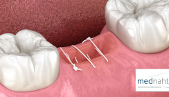 Grundregeln & Tipps zum dentalchirurgischen Nähen