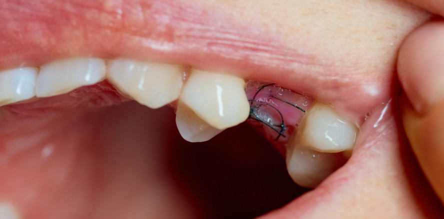 Wund- und Nahtkomplikationen beim dentalchirurgischen Nähen