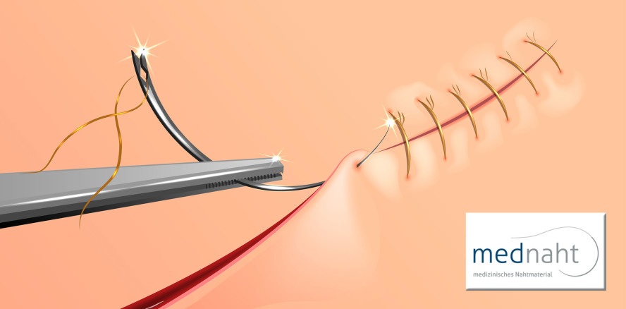 Wundverschlussverfahren und -materialien