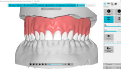 Simplify your (Full)Denture – vereinfacht die CAD-Konstruktion von Totalprothesen