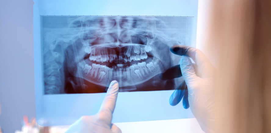 Bewegungsartefakte reduzieren durch 180°-Rekonstruktion