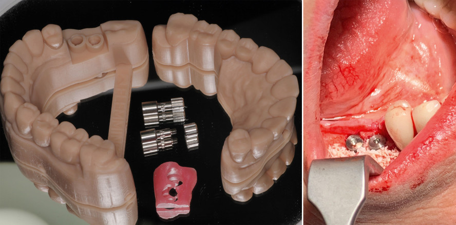Implantate und die digitale Abformung in der modernen Zahnarztpraxis