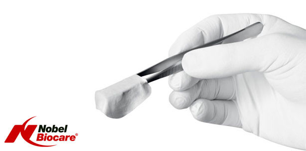 Den richtigen Schutz für die gesteuerte Knochenregeneration auswählen