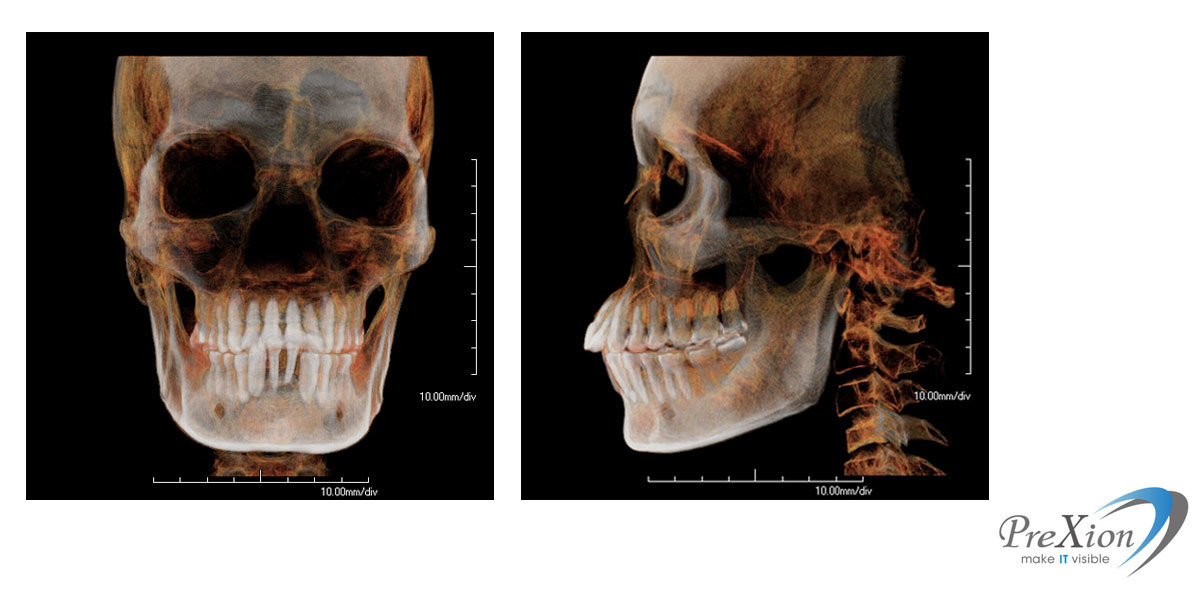 Hohe 3D-Bildqualität bei geringer Strahlenbelastung