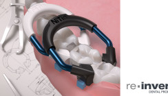 Re-invent Dental Products erfindet das NiTin™ Teilmatrizensystem neu