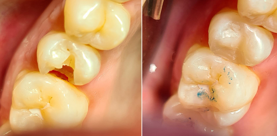 Ästhetische Füllungsversorgung im Seitenzahnbereich