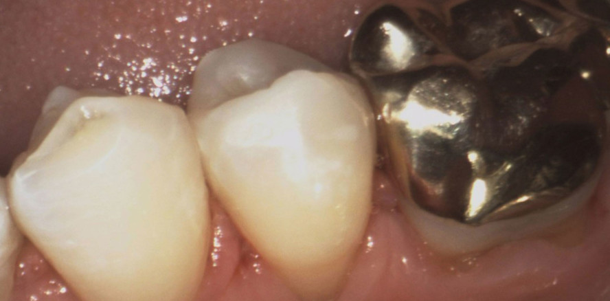 Austausch eines Goldinlays