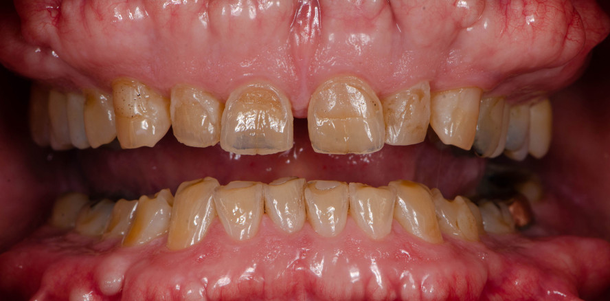 Studie gibt Aufschluss über die Mechanismen der Zahnerosion