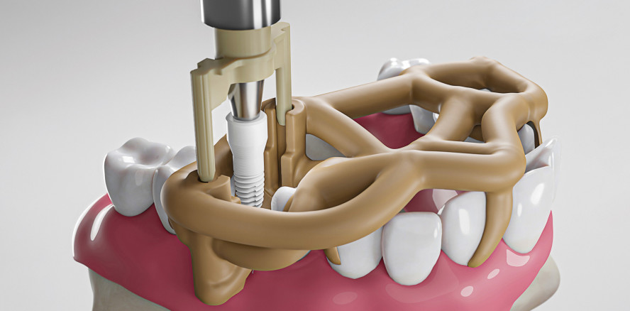 Keramikimplantate: Jetzt einfach, schnell und sicher starten