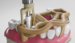 Keramikimplantate: Jetzt einfach, schnell und sicher starten