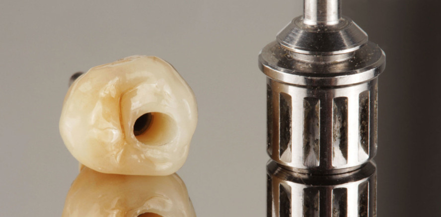 Hybrid-Abutmentkrone aus Zirkon­oxid mit vestibulärem Cut-back