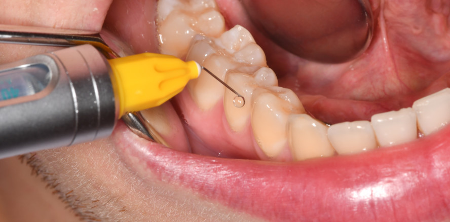 Lokalanästhesie leicht gemacht: 6 Tipps für die Praxis