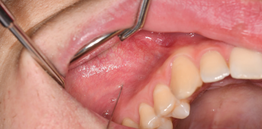 Neue Infokarte von Sanofi: Lokalanästhesie auf einen Blick