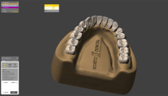 Erweiterte Exocad-Zahnbibliothek exklusiv bei Schütz Dental
