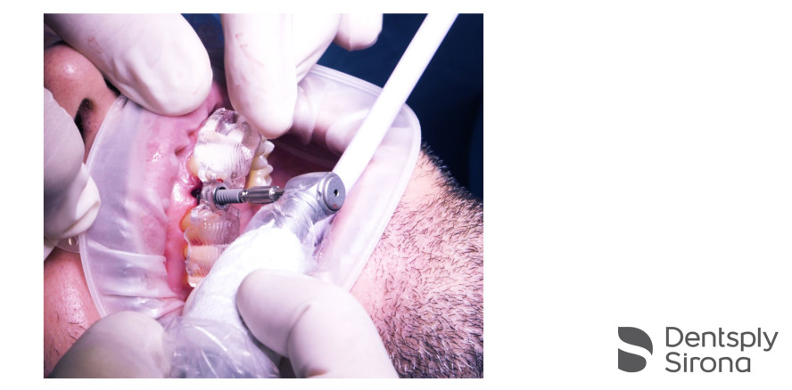 Komplett geführte Implantologie mit CEREC Guide 3