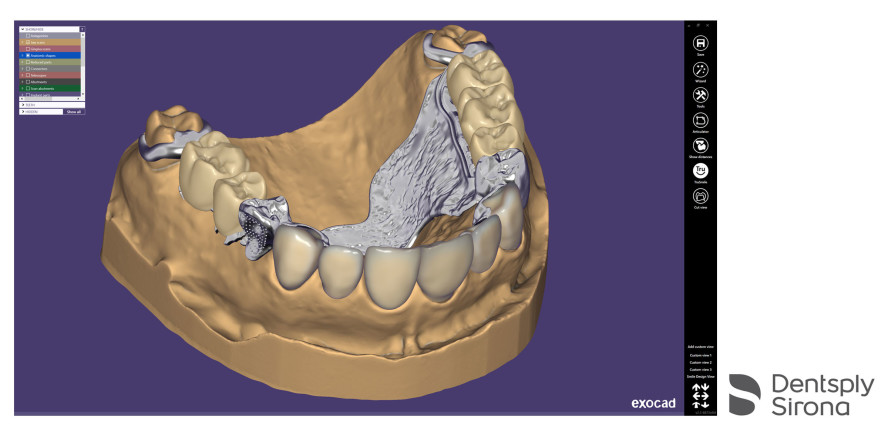 Kooperation von Dentsply Sirona und exocad fördert digitalen Workflow