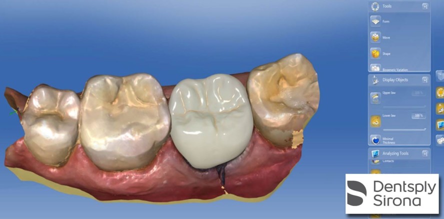 CEREC SW 4.5: Intelligente Software für hervorragende klinische Ergebnissen