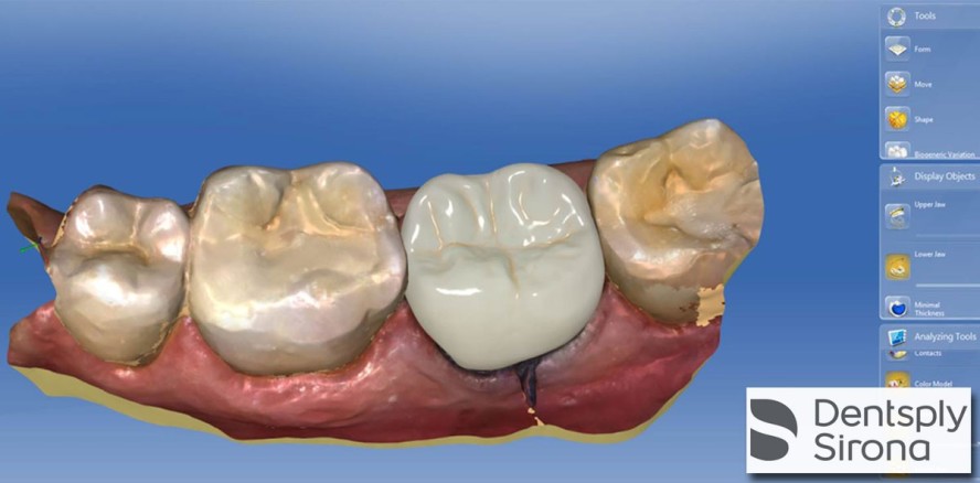 CEREC: Offenes CAD/CAM-Gesamtsystem mit intelligenter Software