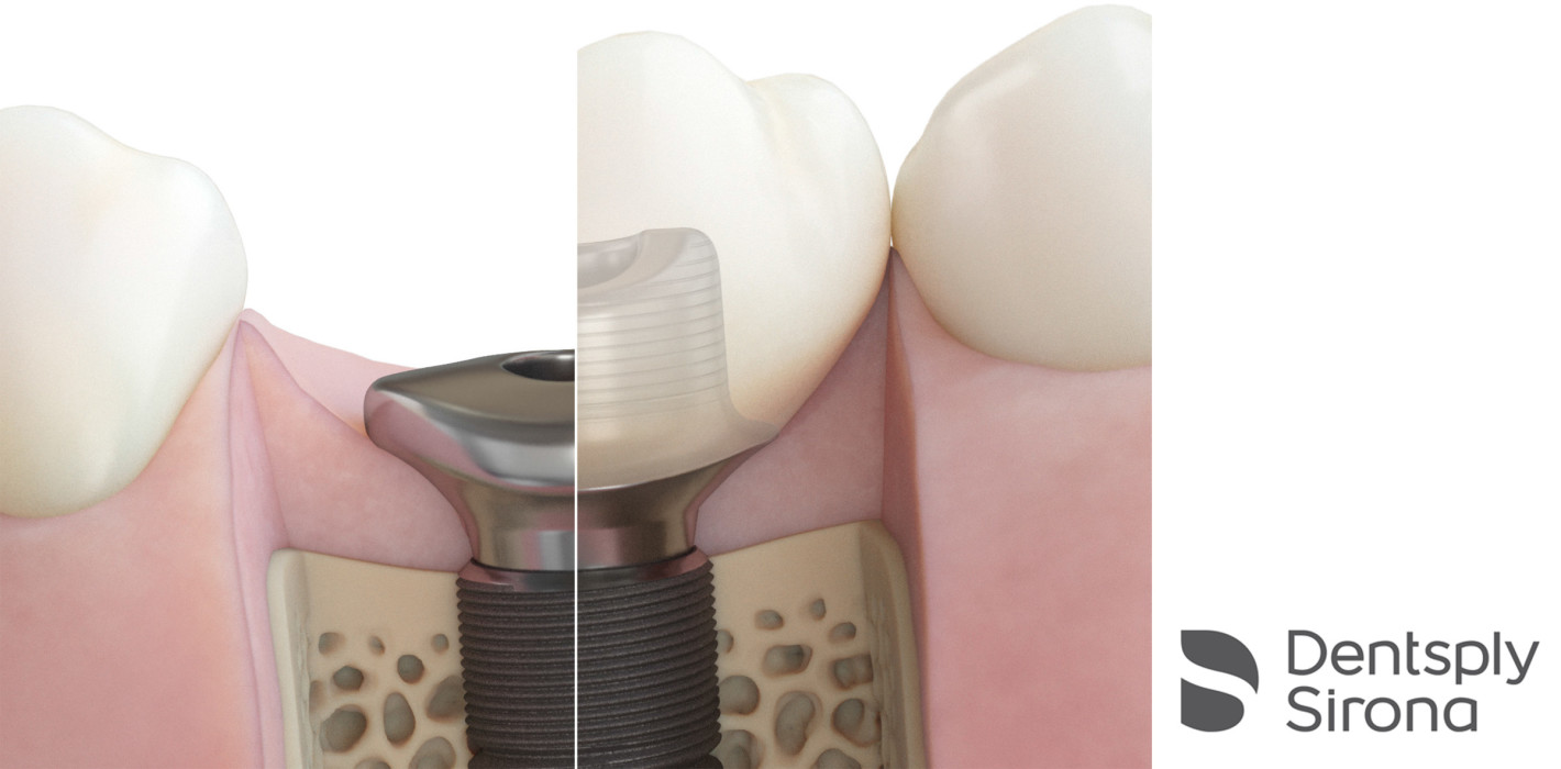 Individueller Gingivaformer schafft neue Möglichkeiten