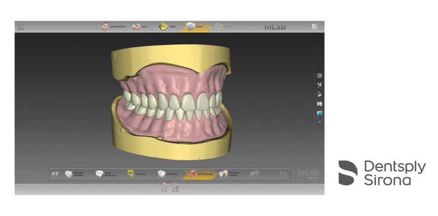 Totalprothese mit inLab Software 20.0 – einfach digital