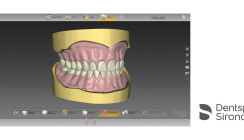 Totalprothese mit inLab Software 20.0 – einfach digital