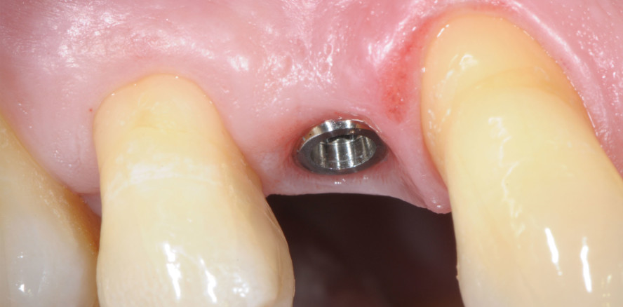 Optimierte nichtaugmentative Implantation im Seitenzahnbereich