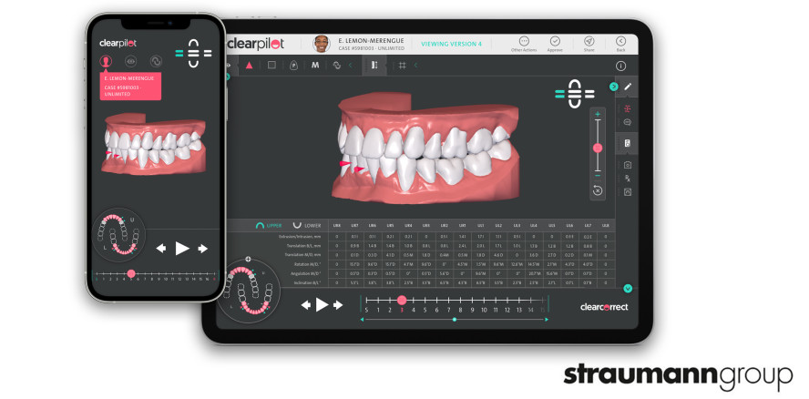 Aligner-Fallplanungen aus einem neuen Blickwinkel