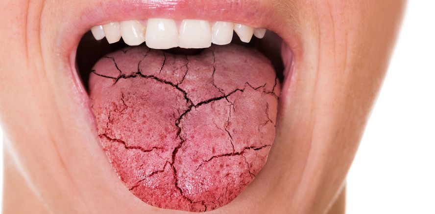 Xerostomie – Wenn der Speichelfluss nachlässt