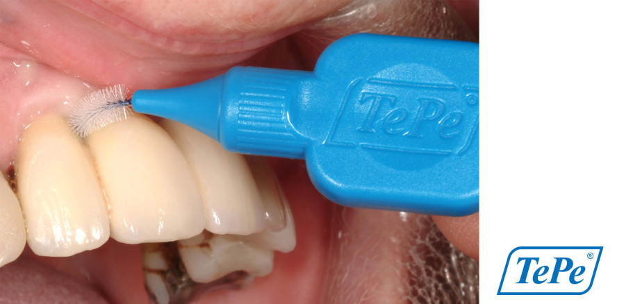 Implantatpflege zur Vermeidung periimplantärer Erkrankungen