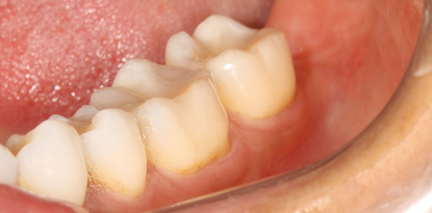 Neue Technologien für optimale Farbanpassung von Komposits